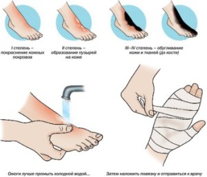 первая помощь при ожогах